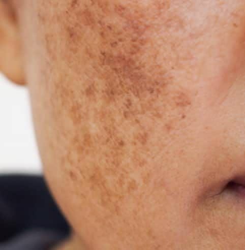Manchas e melasma